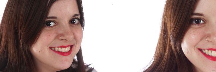 Single Implant Zirconia Crown Case