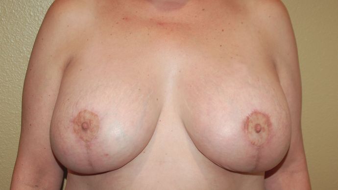 Breast Augmentation w/ Lift: Case 123 - After