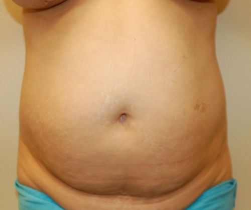 Mommy Makeover Case 53 - Before