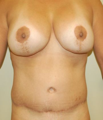 Mommy Makeover: Case 53 - After