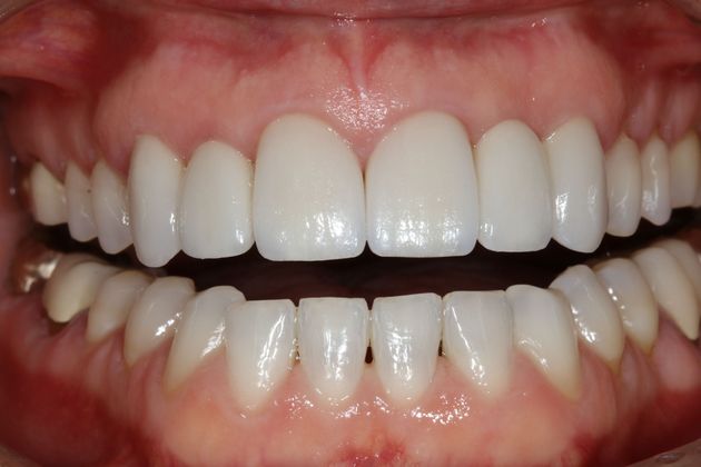 Porcelain bridges: Kim - After