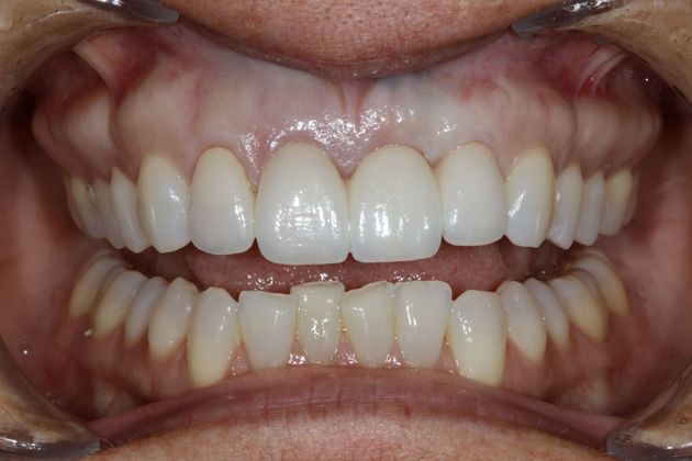 Porcelain bridges: Simone - After