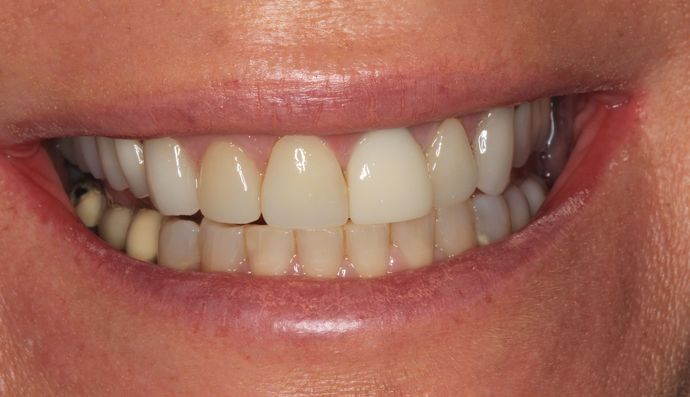 Full Mouth Reconstruction: Case 11 - before