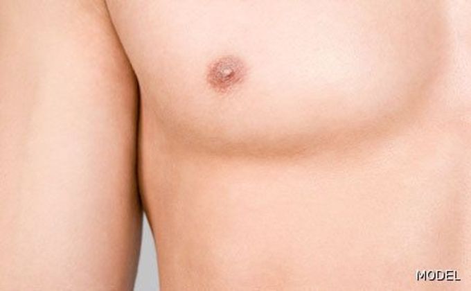 Gynecomastia Surgery (Male Breast Reduction Surgery) Cases
