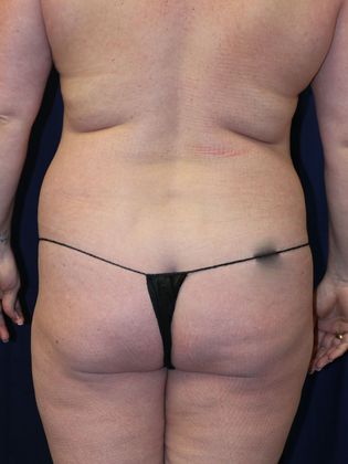 Liposuction & Safe Lipo: Case 16 - Before