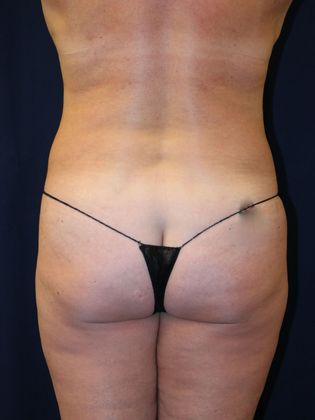 Liposuction & Safe Lipo: Case 16 - After