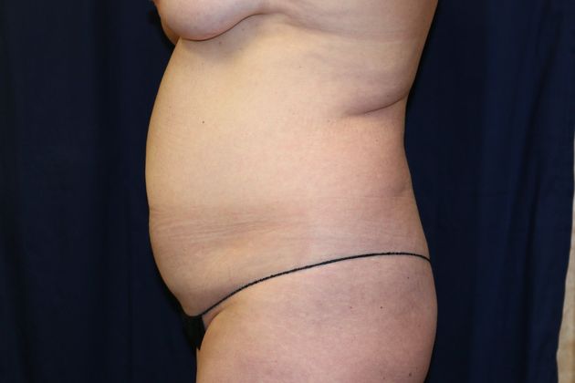 Liposuction & Safe Lipo: Case 16 - Before