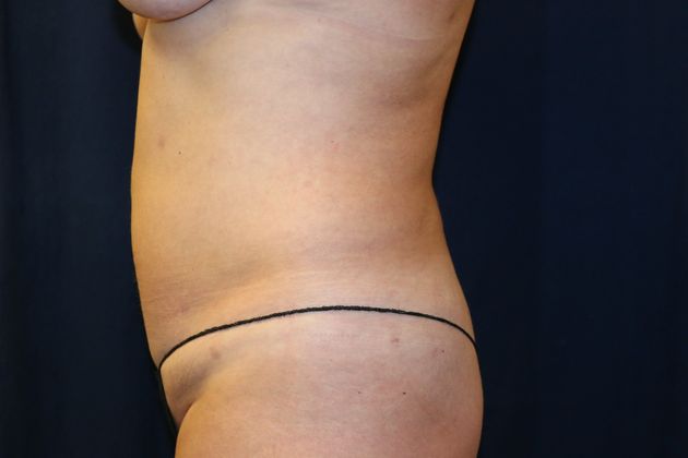 Liposuction & Safe Lipo: Case 16 - After