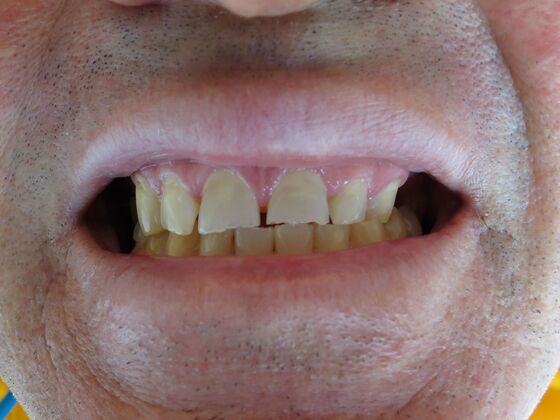 Smile Makeovers, actual cases of our dentists, no special lighting or editing: Case 5 - Before