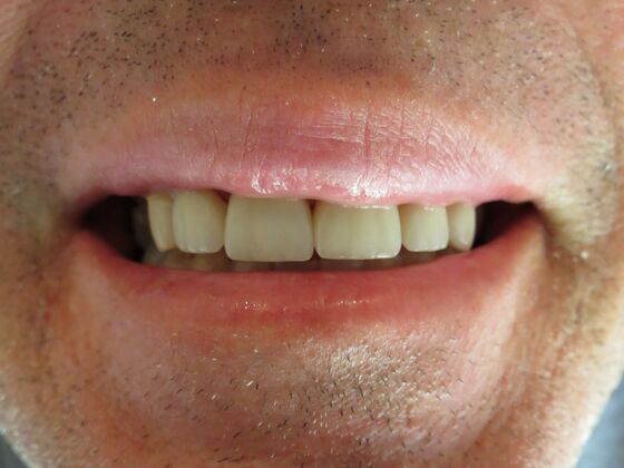 Smile Makeovers, actual cases of our dentists, no special lighting or editing: Case 5 - After