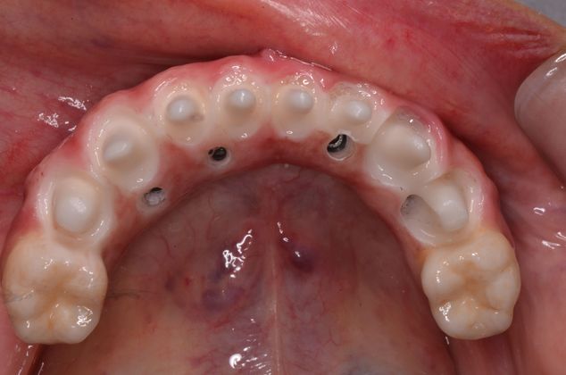 Dental Implants Case 12 - After