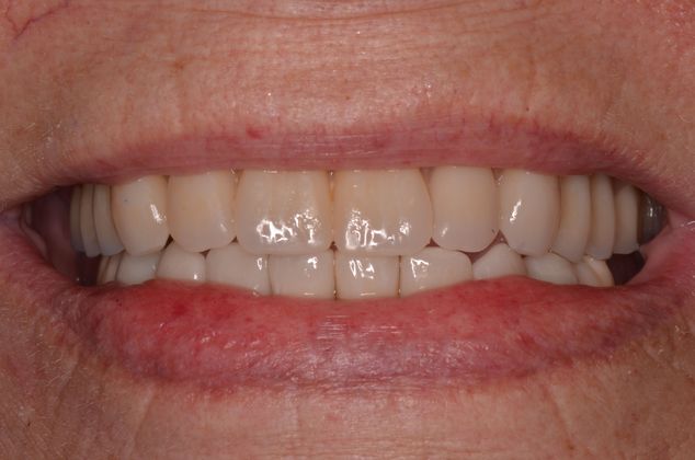Dental Implants: Case 12 - Completed lower hybrid opposing old upper denture