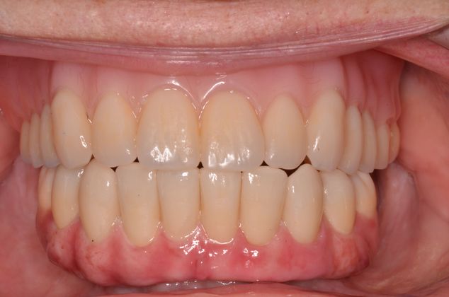 Dental Implants Case 12 - Before