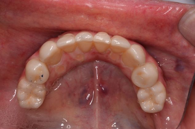 Dental Implants: Case 12 - Final emax crowns bonded onto fixed zirconium hybrid