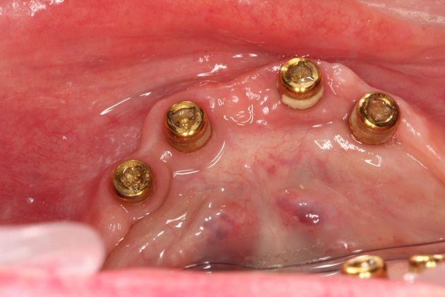 Dental Implants: Case 12 - Original four locators on four lower implants