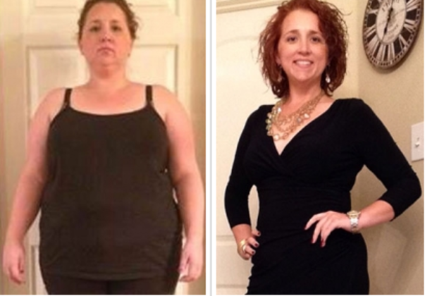 before and after weight loss surgery