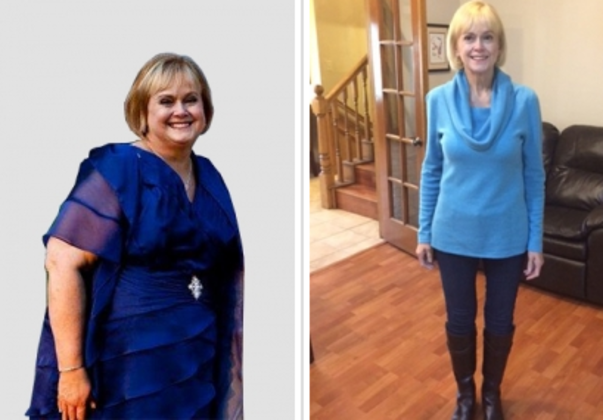 Gastric Sleeve: Case 4 - Before & After
