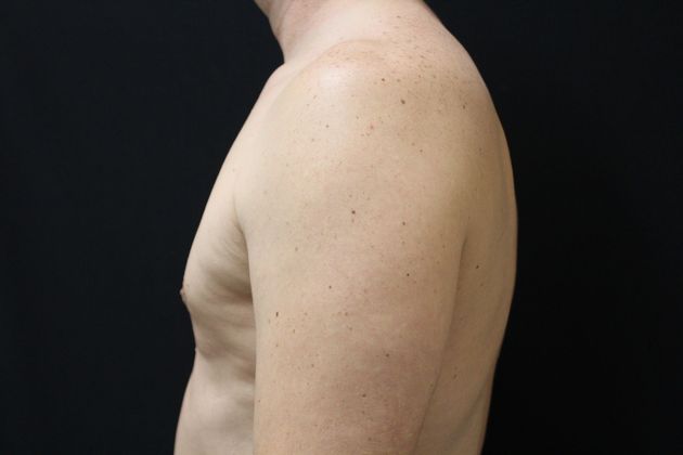Gynecomastia: Case 5 - After