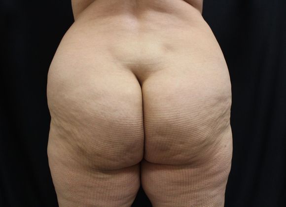 Brazilian Butt Lift Case 1 - Before