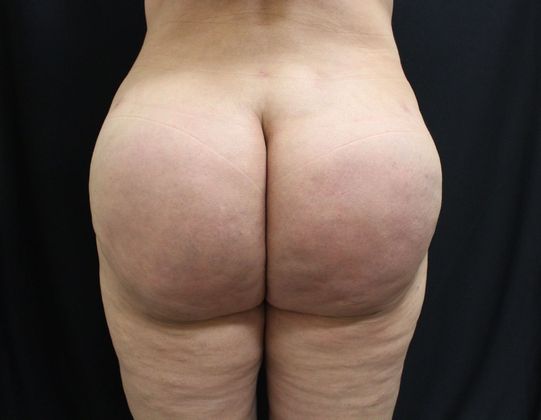 Brazilian Butt Lift Case 1 - After