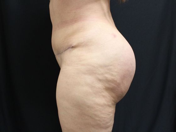 Brazilian Butt Lift: Case 1 - After