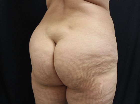 Brazilian Butt Lift: Case 1 - Before