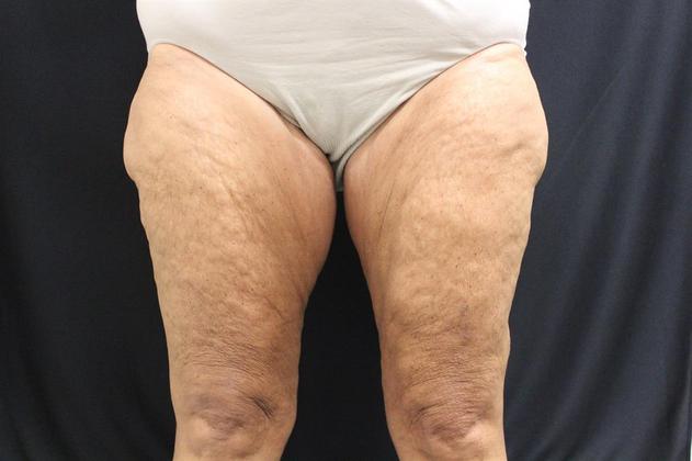 Thigh Lift Case 2 - Before
