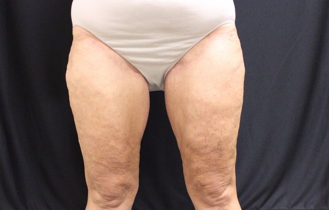 Thigh Lift Case 2 - After
