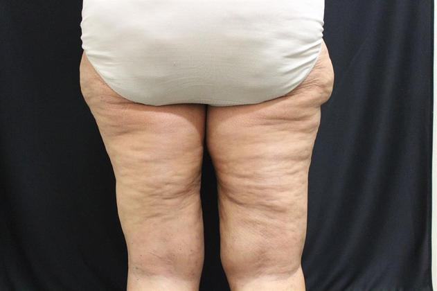 Thigh Lift: Case 2 - Before