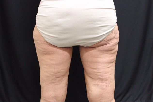 Thigh Lift: Case 2 - After