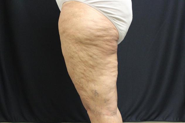 Thigh Lift: Case 2 - Before