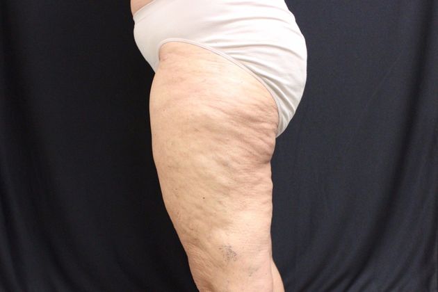 Thigh Lift: Case 2 - After