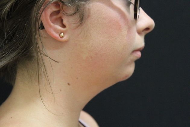 Chin Augmentation: Case 2 - Before