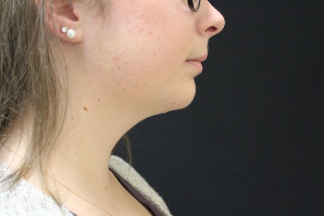 Chin Augmentation: Case 2 - After