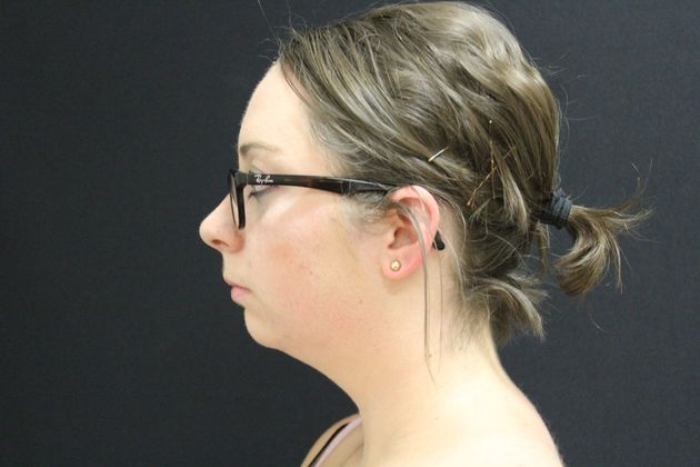 Chin Augmentation: Case 2 - Before