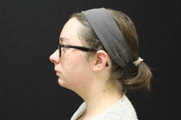 Chin Augmentation: Case 2 - After