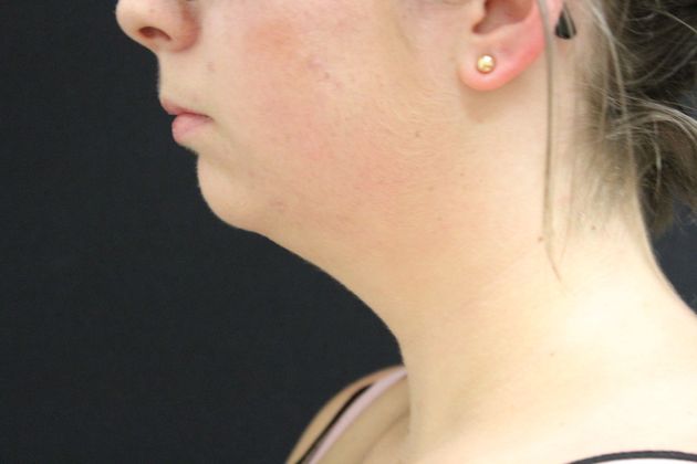 Chin Augmentation: Case 2 - Before