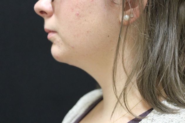 Chin Augmentation: Case 2 - After