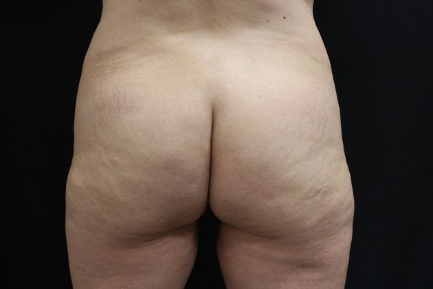 Brazilian Butt Lift: Case 2 - Before