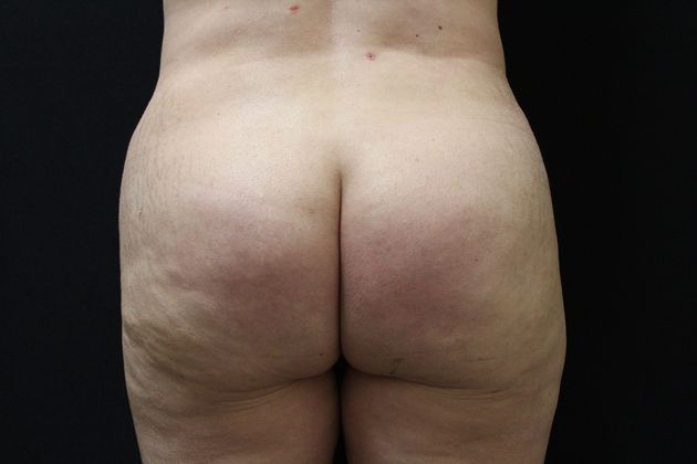 Brazilian Butt Lift: Case 2 - After