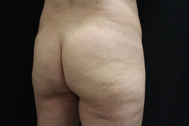 Brazilian Butt Lift: Case 2 - Before