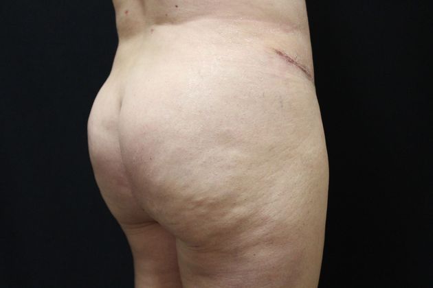 Brazilian Butt Lift: Case 2 - After