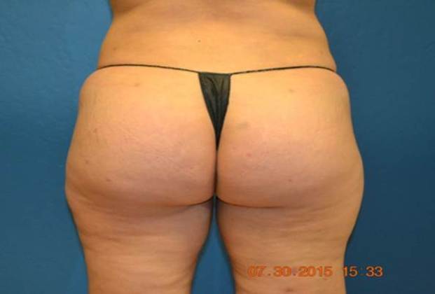 Brazilian Butt Lift Before & After Gallery: Patient 15
