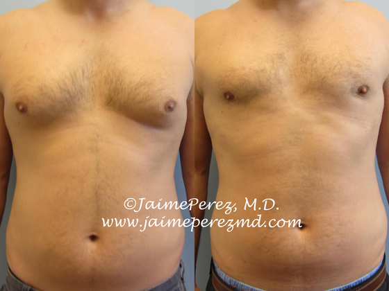 Male Breast Reduction - Gynecomastia - Ocala Plastic Surgery