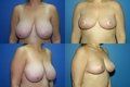 Breast Reduction