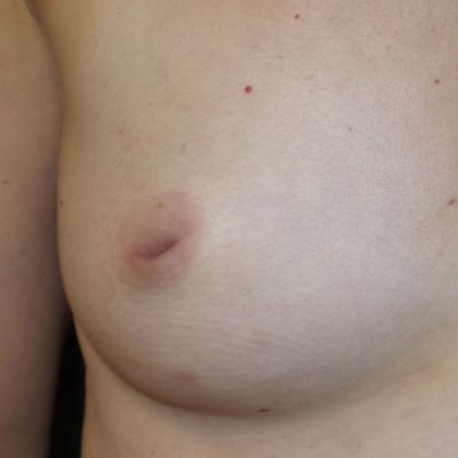 Inverted Nipple Repair Case 5 - Before