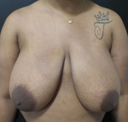 Case 14 - Breast Reduction - Before and After Gallery