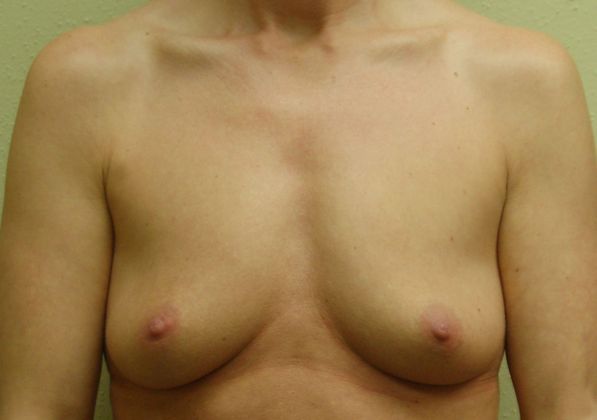 Breast Augmentation Case 290 - Before