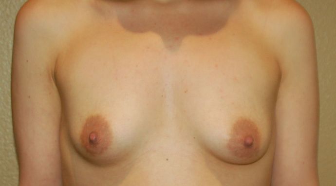 Breast Augmentation Case 292 - Before