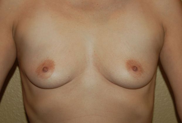 Breast Augmentation w/ Lift Case 130 - Before